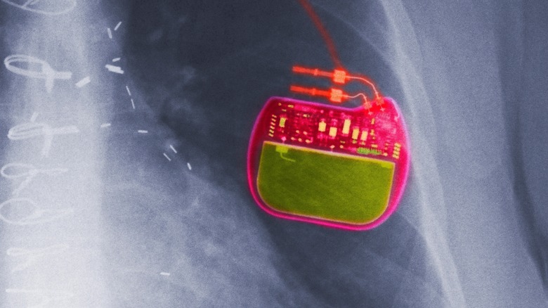 Vagus nerve stimulation device