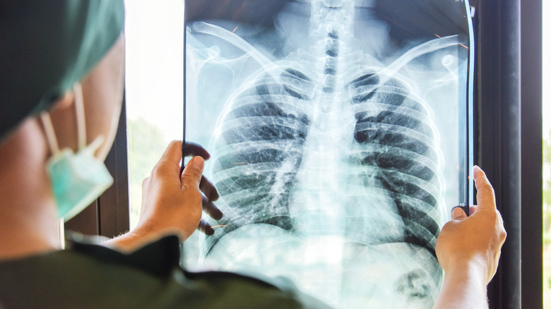 Doctor holding X-ray of lungs