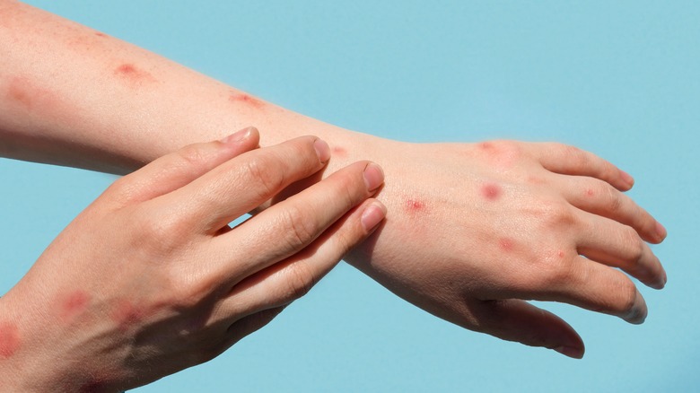 Person with monkeypox rash