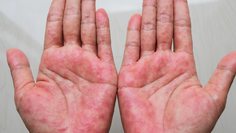 person with contact dermatitis