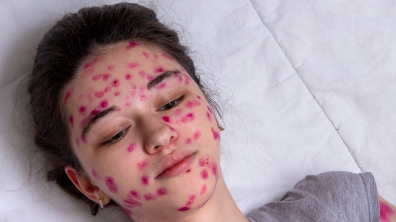 young lady with chicken pox