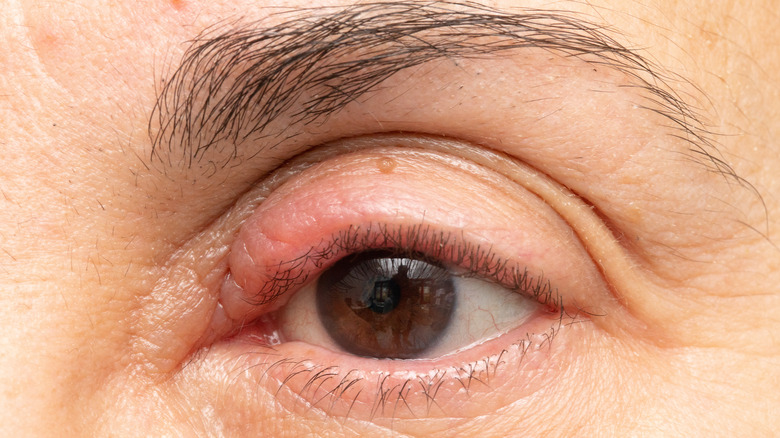 woman with chalazion