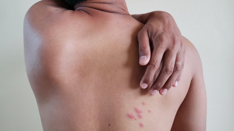 Man with chickenpox on his back