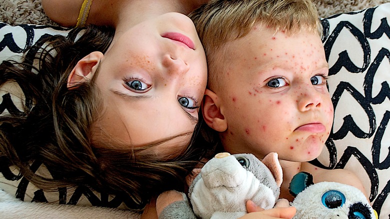 Boy with chickenpox near girl