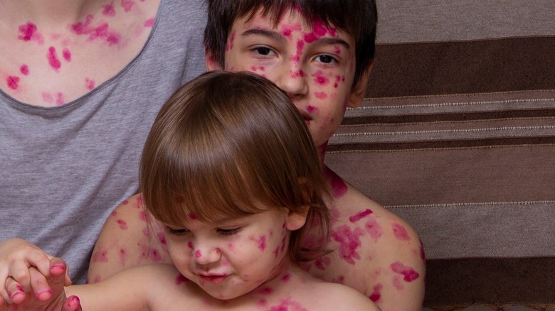 two children with chickenpox
