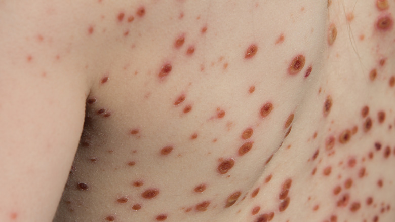 person with chickenpox all over back