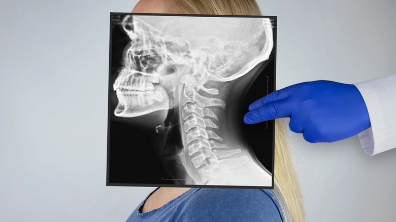 X-Ray of head and neck held in front of woman