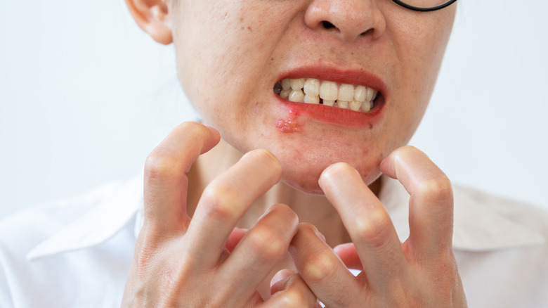 Woman with cold sores looking frustrated