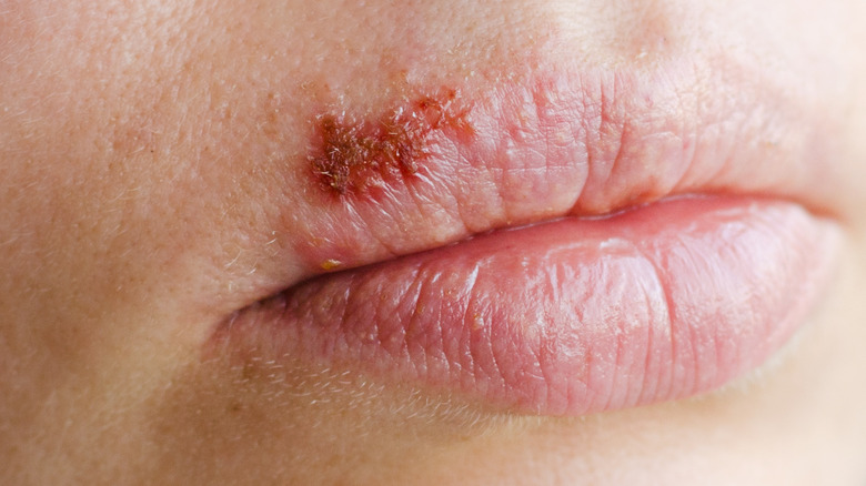 Person with cold sores on their upper lip