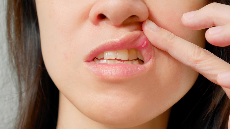 Woman with canker sore on lip 