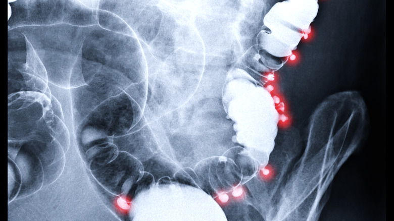 X-ray image of patient with diverticulitis