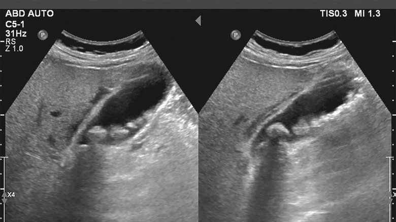 gallstones shown on ultrasound