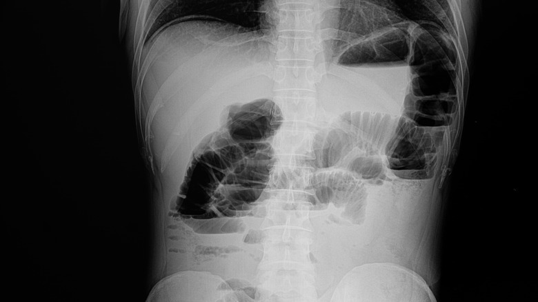 small bowel obstruction x-ray