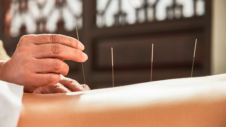 Practitioner placing acupuncture needles on patient
