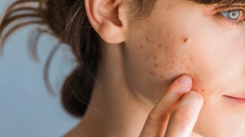 girl examining acne