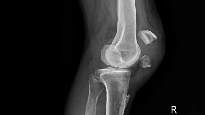 X-ray of a broken bone