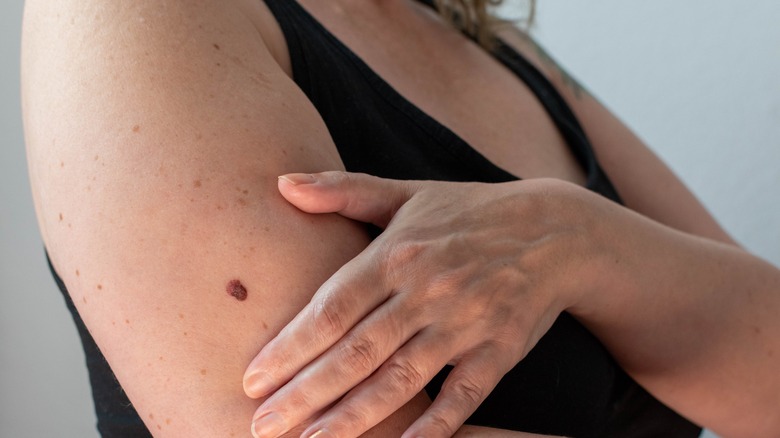 Woman with moles on her arm