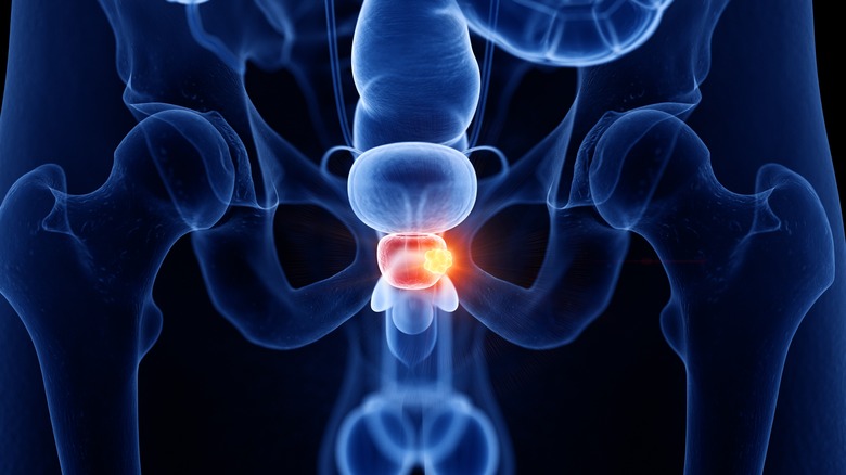 x-ray image of prostate gland