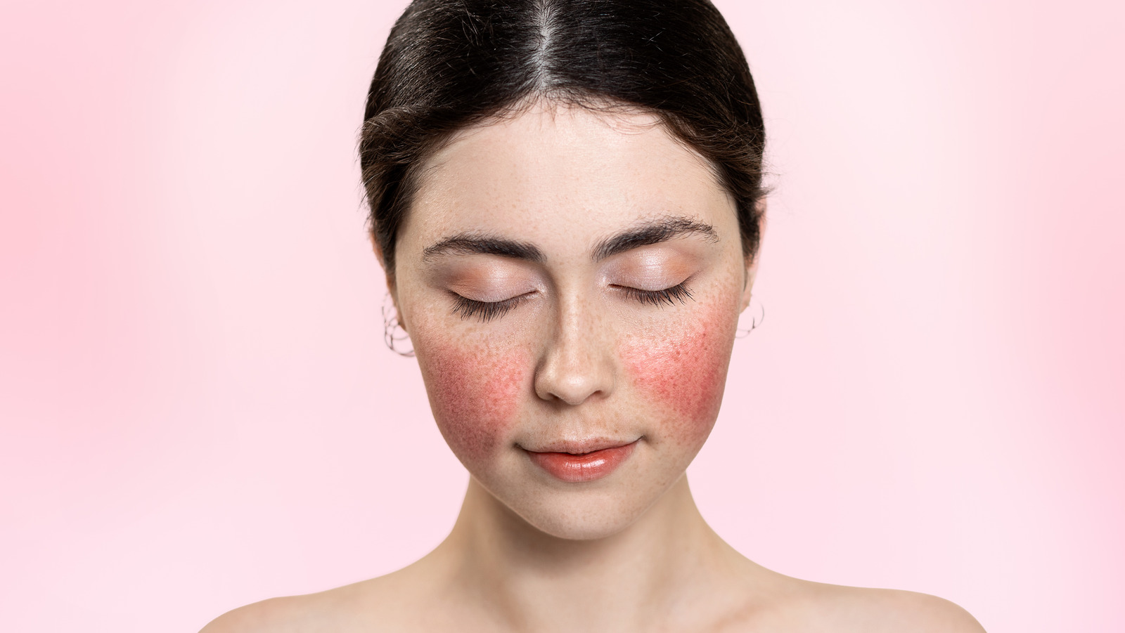 Lupus Butterfly Rash Why Do Patients With Lupus Develop Facial Rashes