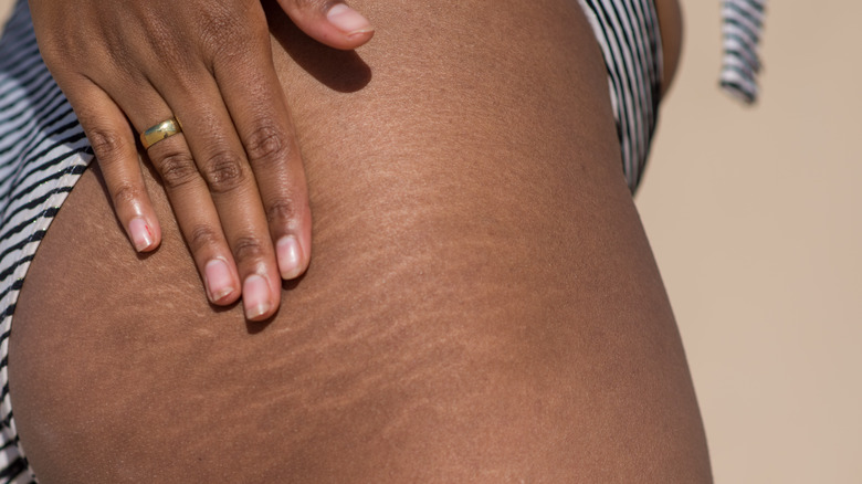 Close up of stretch marks