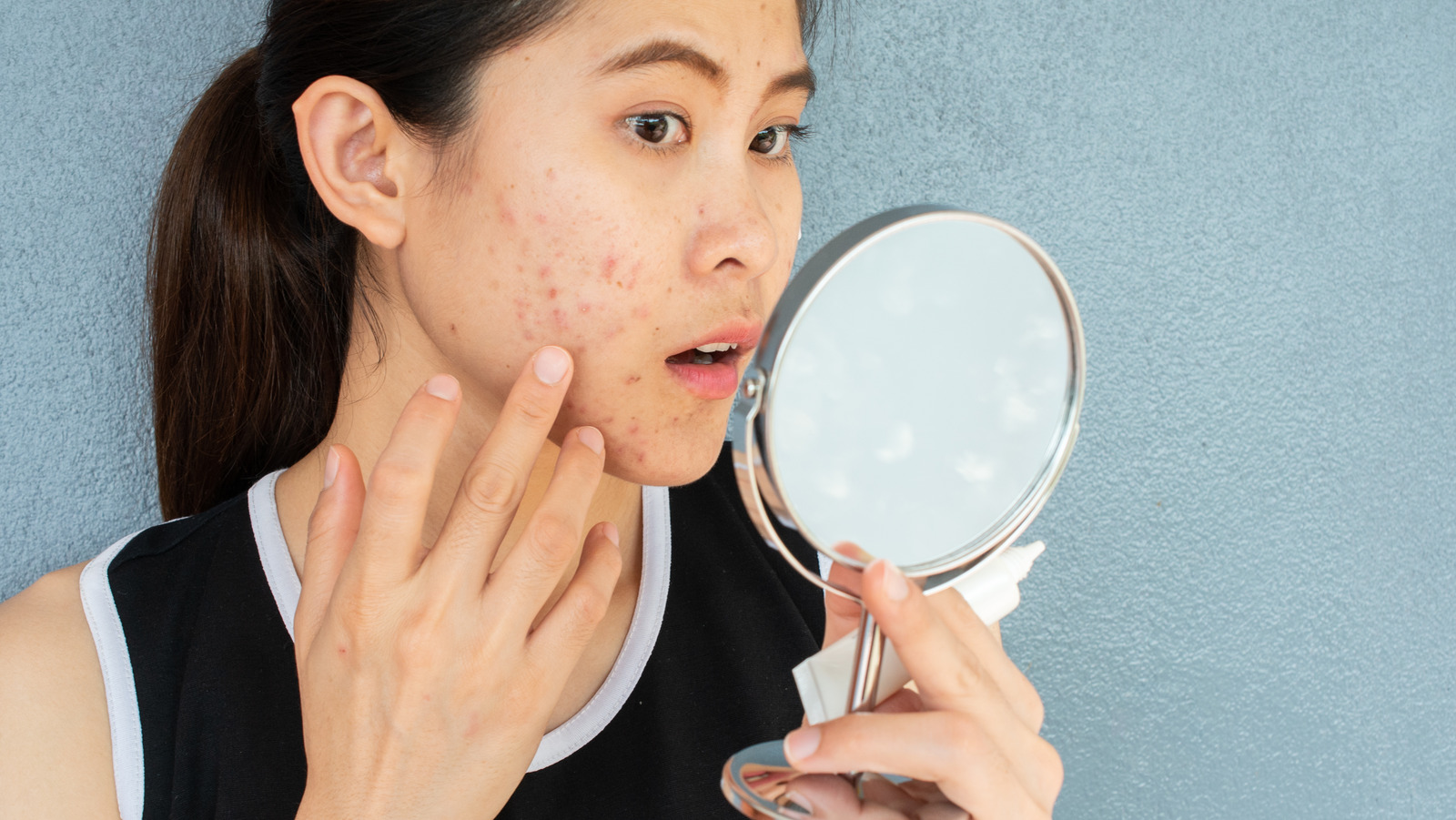 Does Birth Control Help With Acne?