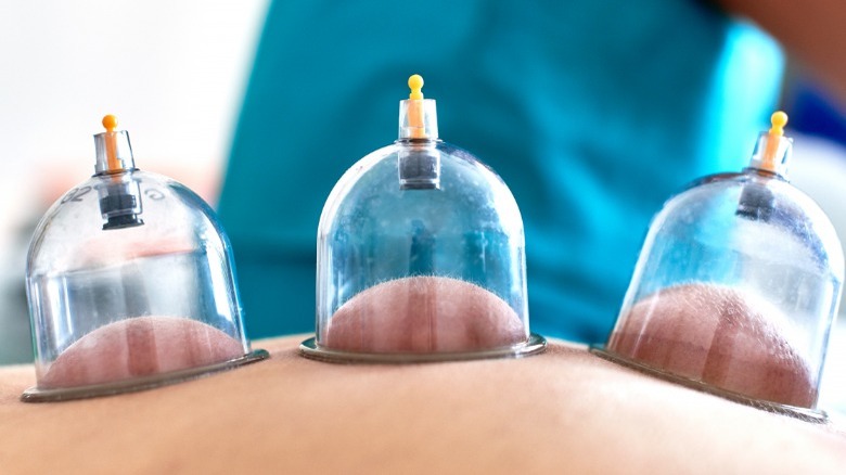 close-up photo of cupping therapy