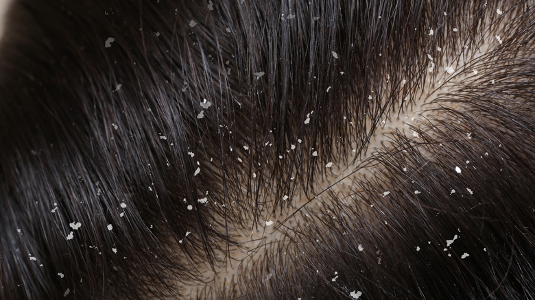 Dandruff close up 