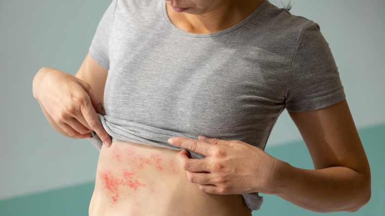 Shingles outbreak on woman's torso