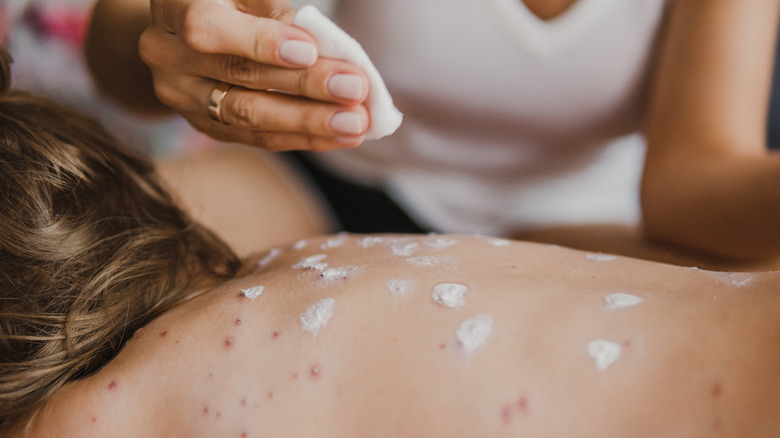 mother applying lotion to chickenpox on child's back