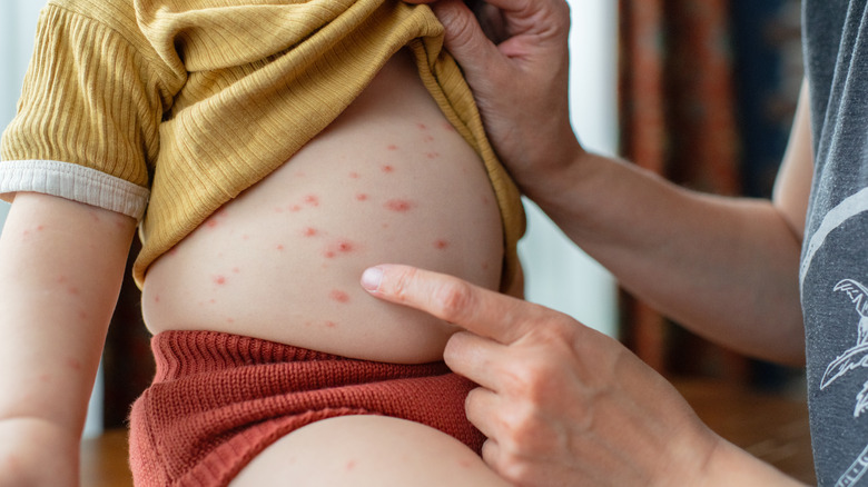 parent looking at child's chickenpox