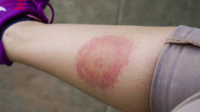 erythema migrans rash from Lyme disease