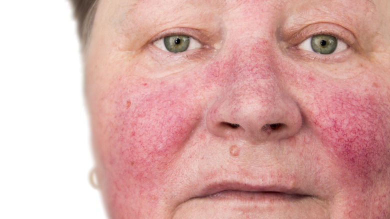 elderly woman with rosacea