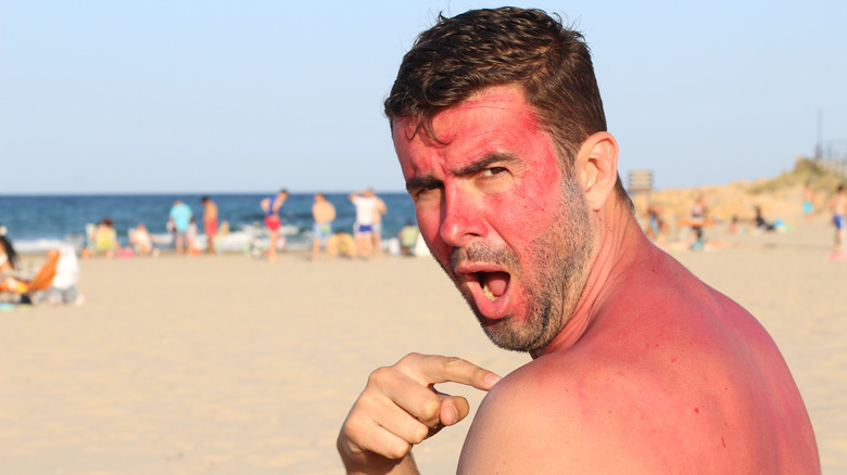 man with sunburn at beach