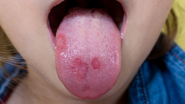 Ulcers on tongue and oral thrush