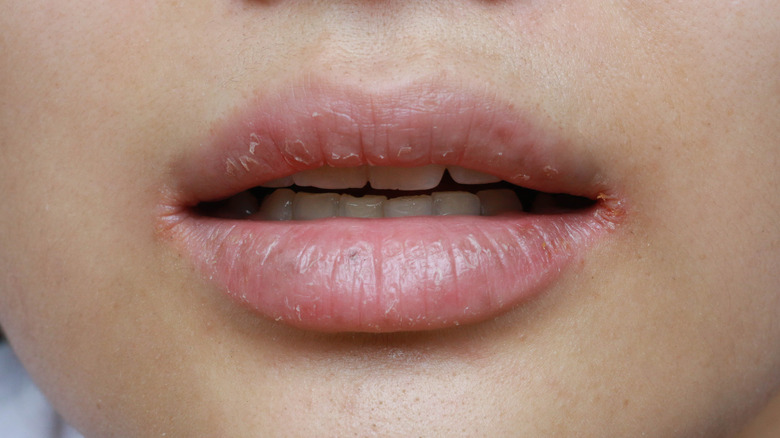 Closeup of woman's chapped lips