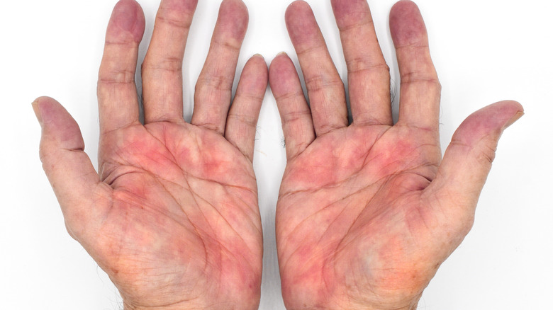 Hands with arthritic "Palmar Erythema" rash