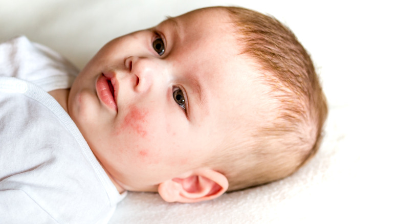 Baby with eczema rash on face