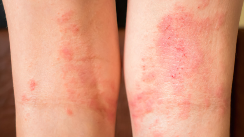 Eczema rash on the the back of knees