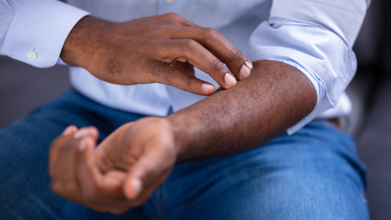 Black man touching a rash on his arm