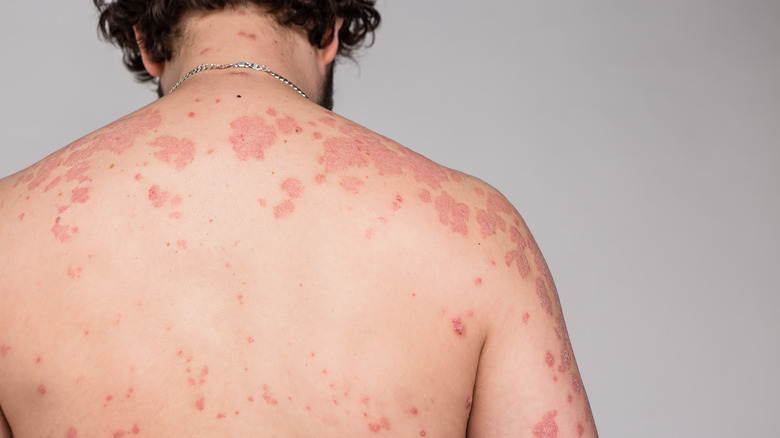 Psoriasis rash on a person's back