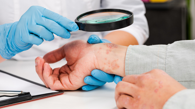 Doctor examining a skin rash