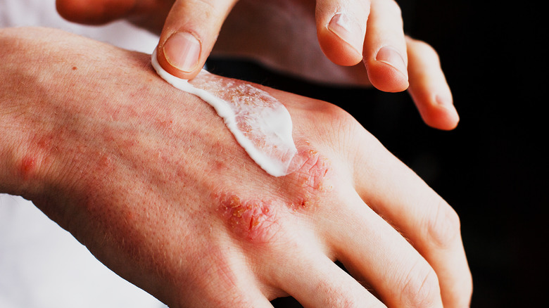 Person applying cream to an eczema rash on their hands