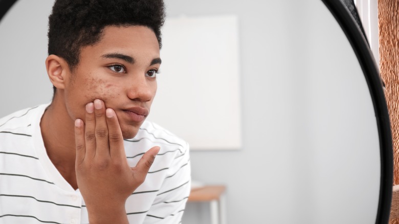 A boy with acne