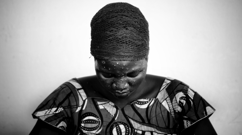 Black and white photo of a woman with monkeypox