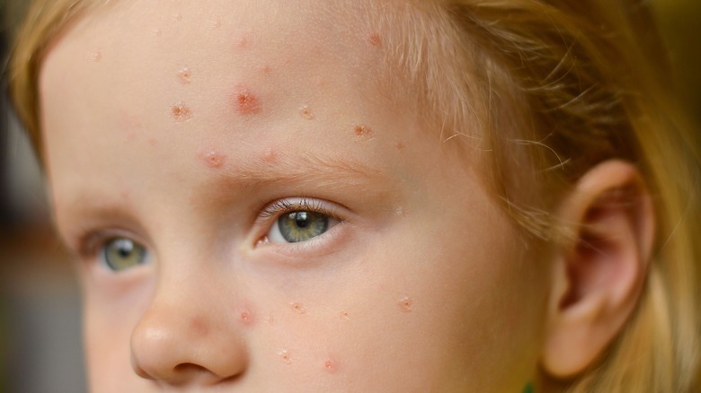 Young child with monkeypox rash on their face