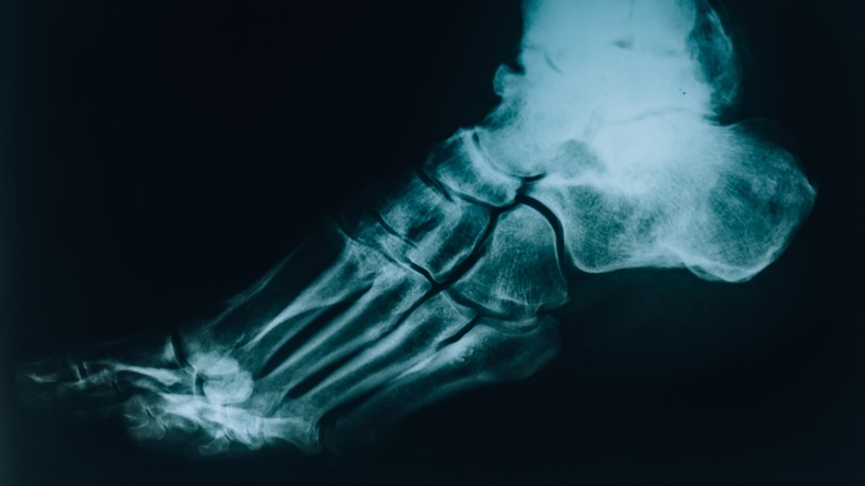 X ray of a broken foot 