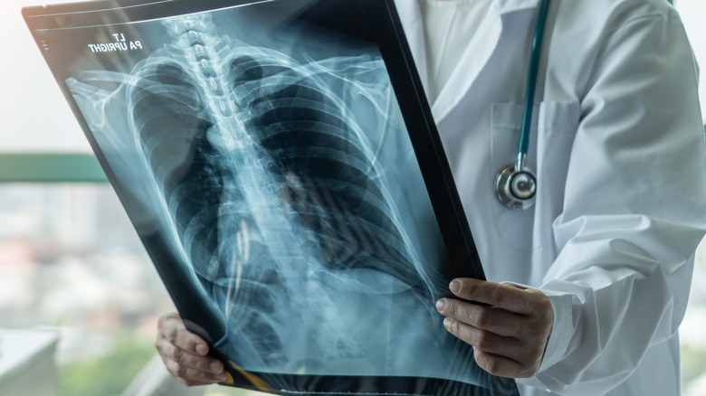 Doctor examining a lung x-ray