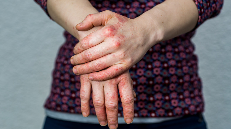 dyshidrotic eczema on a person's hands