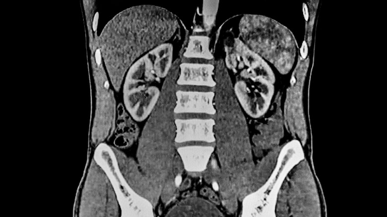 CT scan of kidneys