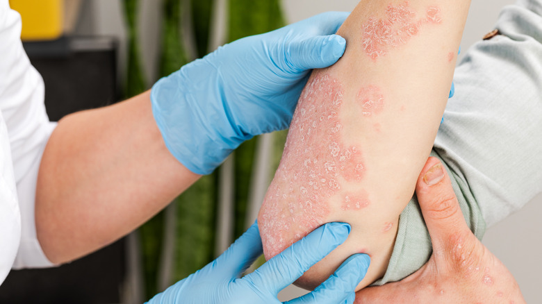 Doctor examining a rash on a person's arm